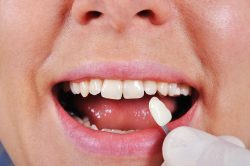 Minimal Prep Veneers Near Me