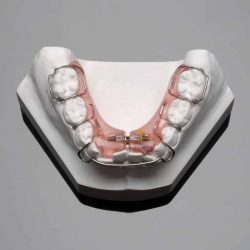 Fix Crowding And Crossbite With Schwartz Expander Appliance