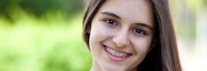 How Much Do Adult Braces Cost? | Dental Teeth Braces For Adults