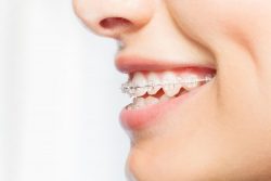 Clear Teeth Aligners, Miami Shores Orthodontist for Braces | Ivanov Ortho