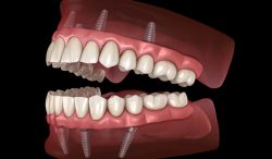 Affordable Dental Implants Near Me