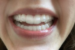 Teeth Bleaching Near Me