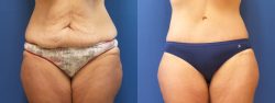 Liposuction Services In Houston