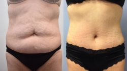 Best Tummy Tuck Surgeon Near Me