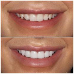 porcelain veneers before and after