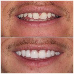 porcelain veneers before and after