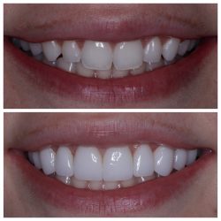 porcelain veneers before and after