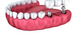 Affordable Dental Implants Near Me