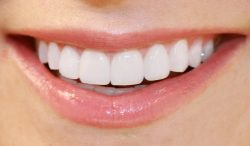 Houston Dentist Veneers For Cosmetic Treatment