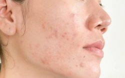 Acne Treatment in Gurgaon