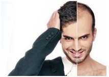 Best Hair Transplant in Bangalore