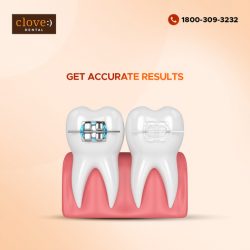 Teeth Braces – Straighten Your Teeth With Clove Dental