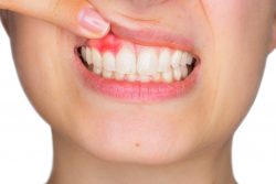 Periodontitis: Symptoms, Causes, and Treatments