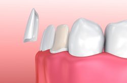 Porcelain Veneers Teeth