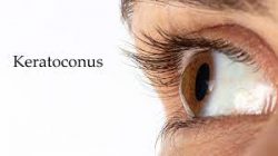 Keratoconus Treatment in India