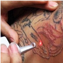 Laser Tattoo Removal Bangalore