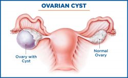 Ovarian Cystectomy surgery In Mumbai