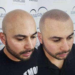 Scalp Co. Scalp Micro Pigmentation