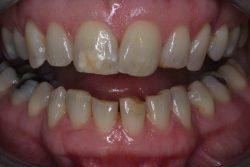 Dental Bonding Procedure