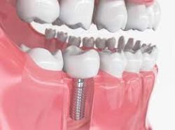 Affordable Dental Implants in Houston