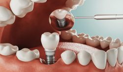 Different Types of Dental Implants