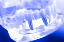 Houston Dental Implant Center