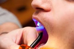 Wisdom Teeth Removal in Miami, FL