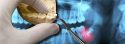 Emergency Dental Extraction Near Me