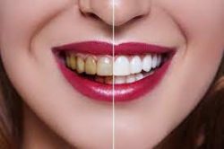 Teeth Whitening and Teeth Bleaching