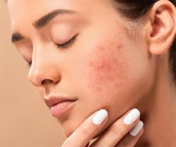 Acne scars