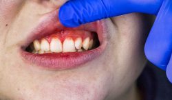 Periodontal Disease Treatment Near Me