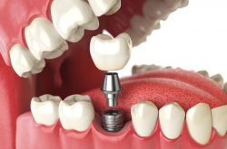 Dental Implant Specialist Near Me