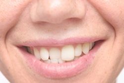 Veneers On Crooked Teeth