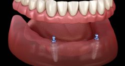 Dental Implant Center in Houston, TX