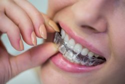 Find Local Braces Dentist Near Me