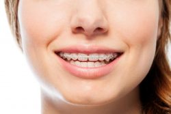 Find Local Braces Dentist Near Me