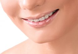 Find Local Braces Dentist Near Me