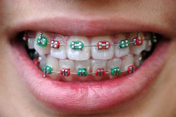 Braces power chain colors