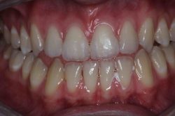 Fix Cavity on Front Tooth | Composite Front Tooth Cavity Filling or Bonding