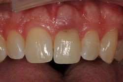 Fix Cavity on Front Tooth | Composite Front Tooth Cavity Filling or Bonding