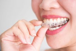 What Are Invisalign Attachments?