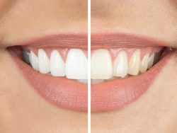 Teeth Whitening and Teeth Bleaching