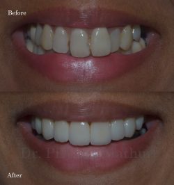 Dental Veneers Cost Near Me