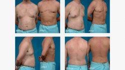 Laser Fat Removal Options, Costs, and Results