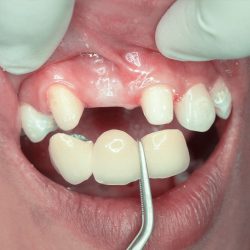 Affordable Dental Crowns Near Me