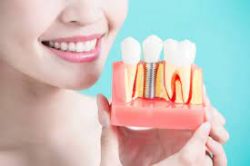 Affordable Dental Implants Near Me