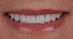 Dental Veneers in Houston, TX