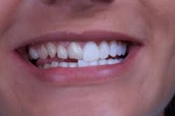 Porcelain Veneers Near Me