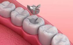 Types of Dental Fillings | Porcelain Composite Fillings | Amalgam fillings