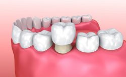 Procedure for Dental Crowns